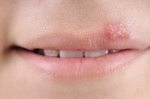 cold sores (herpes simplex) virus and dementia link