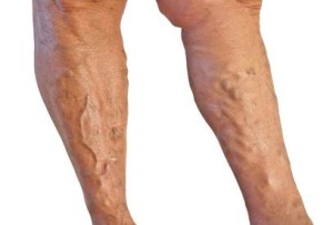 Varicose Veins image