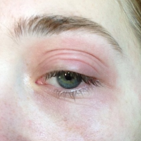 Eczema on Eyelid