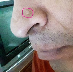 Pimple.jpg
