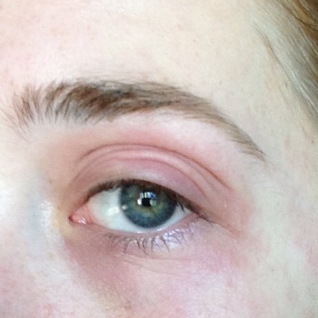 Eczema on Eyelid 2