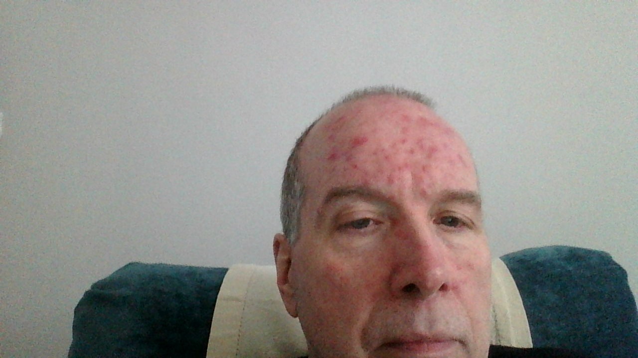 rash on forehead