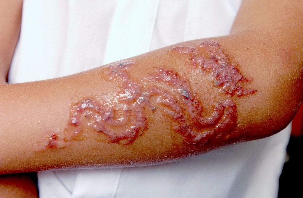 Don't let your child have so-called black henna tattoos this summer